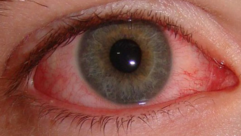 Электроофтальмия глаза